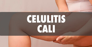 Celulitis en Cali - Salud y Estética TV